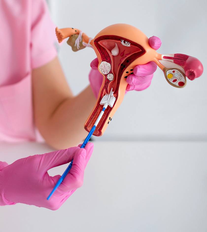 IUI treatment in chennai (Intrauterine Insemination)